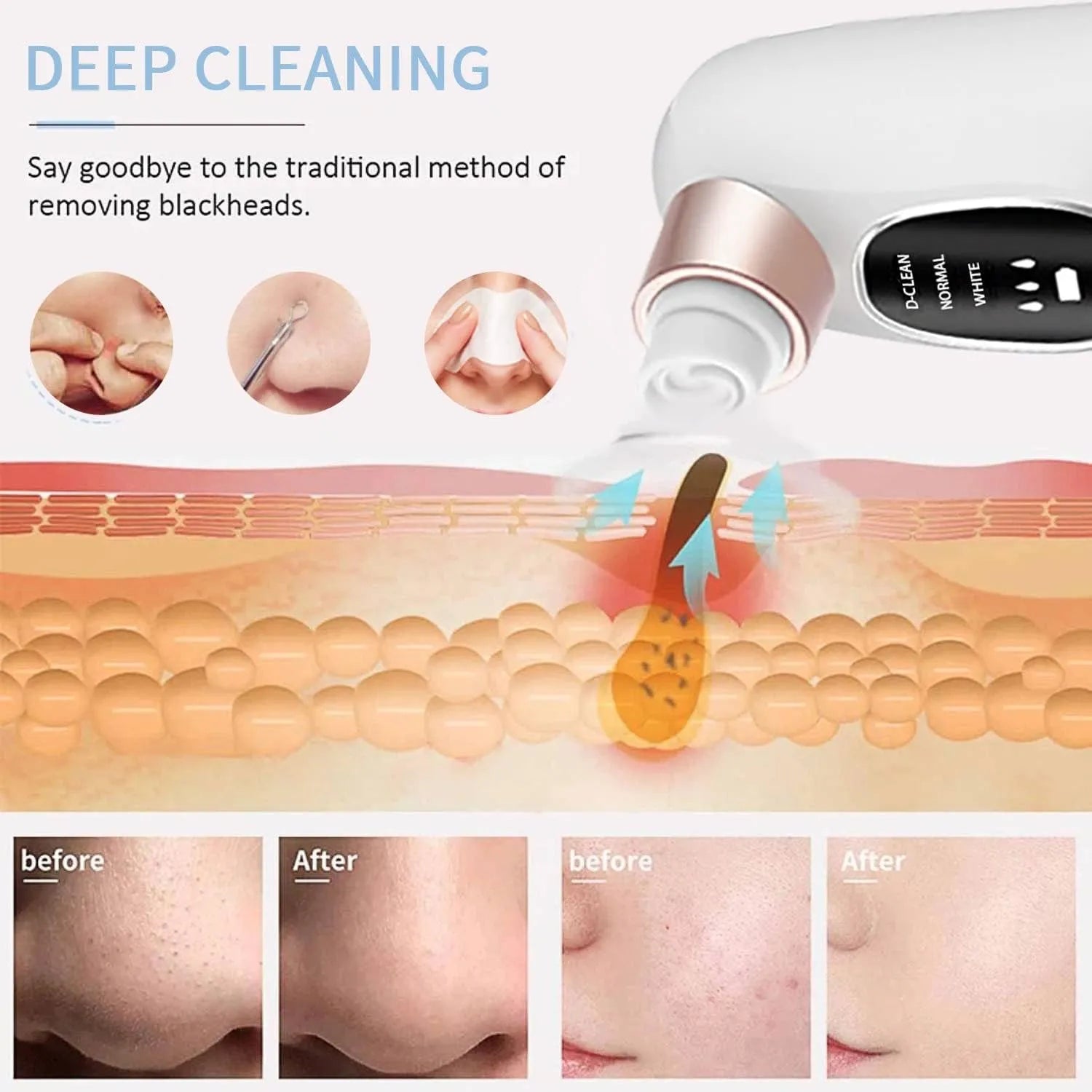 Electric Deep Cleansing Blackhead Remover with Vacuum Suction, 3 Levels & Dual Water Tank System